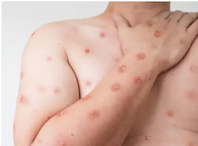 अफ्रिका बाहिर स्विडेनमा देखियो मंकीपक्स